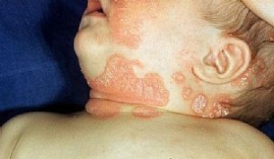 Jó életminőség pikkelysömörrel - így igenis lehetséges
