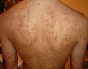 Kellemetlen viszketés: Így támad az ekcéma