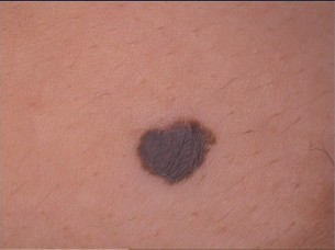 Kockázat a testben - ezért kell az anyajegyet eltávolítani, ha a bőrgyógy�