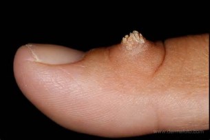 Küzdelem a szemölcsök ellen - a bőrgyógyász tanácsai