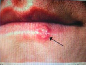 Megtévesztő - komoly betegség bújhat meg egy kis seb mögött