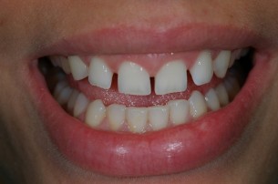 Metszőfogak közti rés: ilyen esetben mindenképpen kezelni kell