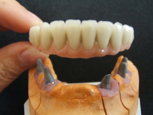 Mindig hiányozni fog! Esetek, amikor kizárt az implantációs fogpótlás