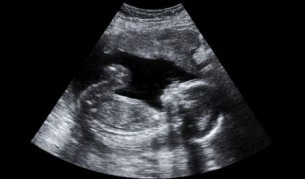 Nagyér transzpozíció: Ez ez egyik legsúlyosabb magzati szívhiba