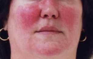 Nem egyszerű bőrpír: Valóban eltüntethetetlen a rosacea?