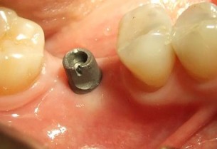 Nem fog fájni? Erre számíthatsz, ha pótolni kell a fogadat