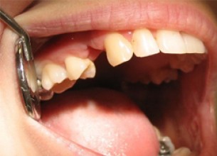 Nincs csiszolás nélküli fogpótlás