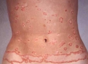 Pikkelysömör értékelése - Mikortól súlyos?