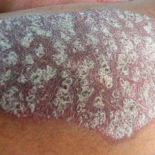 Pikkelysömörösök figyelem! Ezek a biológiai terápia előnyei