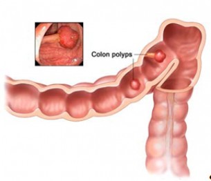 Polipok a vastagbélben