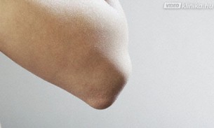 Porcelánbőr: akár pikkelysömört is jelezhet