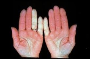 Raynaud-kór - a fiatal nők rejtélyes keringési betegsége