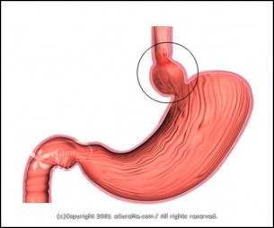 Reflux - Gyakori és nehezen diagnosztizálható betegség