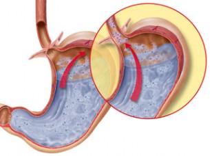 Reflux (Dr. Beró Mariann gasztroenterológus, belgyógyász) 