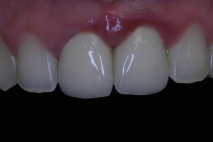 Sosem gondolnál rá, pedig ettől is begyulladhat az ínyed