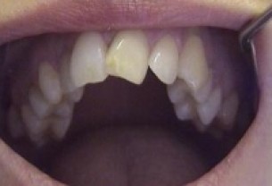 Sűrű fogsor - a fogkő melegágya