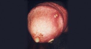 Tripper: a nemi élet fájdalmas gyilkosa