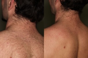 Végleges szőrtelenítés: A hegesedés is végleges?