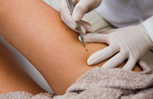 Vissza a természethez: Életmódváltás melanoma után